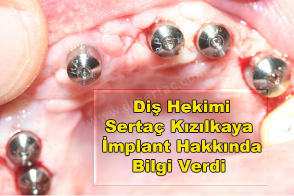 İmplant diş süresi