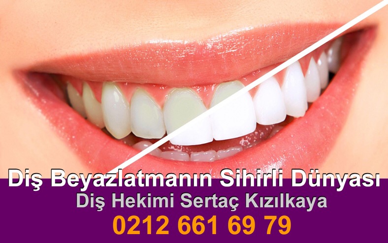 Diş Beyazlatma fiyatları ne kadar?